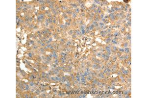 Immunohistochemistry of Human ovarian cancer using PSMD9 Polyclonal Antibody at dilution of 1:40 (PSMD9 抗体)