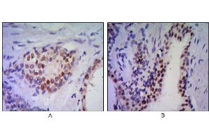 Immunohistochemical analysis of paraffin-embedded human prostata tissues (A, B) using anti-NKX3A antibody with DAB staining. (NKX3-1 抗体)