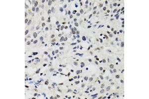 Immunohistochemistry of paraffin-embedded human lung cancer using SMARCAD1 antibody (ABIN2560015) at dilution of 1:100 (40x lens). (SMARCAD1 抗体)