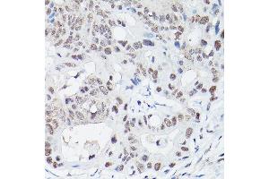 Immunohistochemistry of paraffin-embedded human colon carcinoma using DNA Ligase IV Rabbit pAb (ABIN3022474, ABIN3022475, ABIN3022476 and ABIN6218843) at dilution of 1:100 (40x lens). (LIG4 抗体  (AA 612-911))