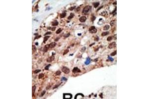 Formalin-fixed and paraffin-embedded human cancer tissue reacted with the primary antibody, which was peroxidase-conjugated to the secondary antibody, followed by DAB staining. (SET7 抗体  (AA 159-189))