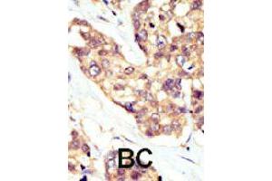 Formalin-fixed and paraffin-embedded human cancer tissue reacted with DOK5 polyclonal antibody  , which was peroxidase-conjugated to the secondary antibody, followed by AEC staining. (DOK5 抗体  (AA 276-306))