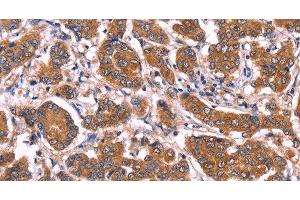 Immunohistochemistry of paraffin-embedded Human breast cancer tissue using COL20A1 Polyclonal Antibody at dilution 1:40 (COL20A1 抗体)