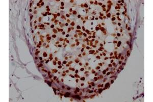 IHC image of ABIN7127498 diluted at 1:100 and staining in paraffin-embedded human breast cancer performed on a Leica BondTM system. (Recombinant FOXA1 抗体)