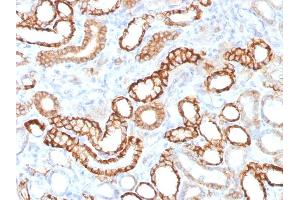 Formalin-fixed, paraffin-embedded human Renal Cell Carcinoma stained with KSP-Cadherin Rabbit Recombinant Monoclonal Antibody (CDH16/1532R) (Recombinant Cadherin-16 抗体)