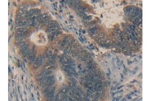 Detection of FASL in Human Colorectal cancer Tissue using Polyclonal Antibody to Factor Related Apoptosis Ligand (FASL)