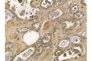 NSMAF Mouse Monoclonal Antibody at 1/100 staining human ovarian cancer by IHC-P. (NSMAF 抗体)