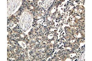 Immunohistochemistry of paraffin-embedded human breast carcinoma using Phospho-DOK2-Y299 antibody (ABIN2987731). (DOK2 抗体  (pTyr299))