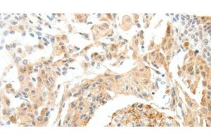 Immunohistochemistry of paraffin-embedded Human cervical cancer tissue using SEMA3D Polyclonal Antibody at dilution 1:50 (SEMA3D 抗体)