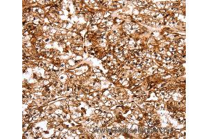 Immunohistochemistry of Human thyroid cancer using SLC9A3R2 Polyclonal Antibody at dilution of 1:40 (SLC9A3R2 抗体)