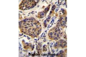 YOD1 Antibody (C-term) immunohistochemistry analysis in formalin fixed and paraffin embedded human bladder carcinoma followed by peroxidase conjugation of the secondary antibody and DAB staining. (YOD1 抗体  (C-Term))