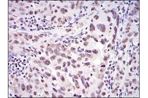Immunohistochemical analysis of paraffin-embedded endometrial cancer tissues using XRCC6 mouse mAb with DAB staining. (XRCC6 抗体  (AA 6-214))