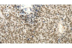 Immunohistochemistry of paraffin-embedded Human ovarian cancer tissue using Frizzled 10 Polyclonal Antibody at dilution 1:50 (FZD10 抗体)