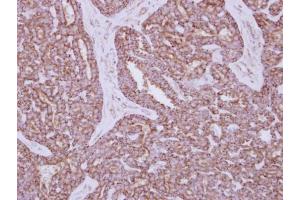 IHC-P Image Immunohistochemical analysis of paraffin-embedded human breast cancer, using HXK I, antibody at 1:250 dilution. (Hexokinase 1 抗体)