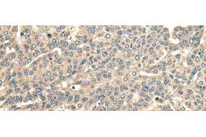 Immunohistochemistry of paraffin-embedded Human liver cancer tissue using CCDC113 Polyclonal Antibody at dilution of 1:65(x200) (CCDC113 抗体)