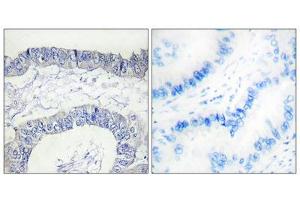 Immunohistochemistry analysis of paraffin-embedded human lung carcinoma tissue, using FA12 (heavy chain, Cleaved-Ile20) antibody. (F12 抗体  (Cleaved-Ile20, Heavy Chain, N-Term))