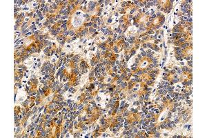 ABIN7095898 and ABIN7099960 at 1/100 staining human colorectal cancer and adjacent non-tumor tissue by IHC-P. (TRIML2 抗体)