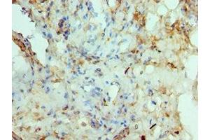 Immunohistochemistry of paraffin-embedded human prostate cancer using ABIN7150291 at dilution of 1:100 (RAD51D 抗体  (AA 1-328))