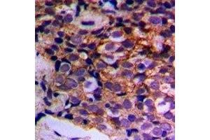 Immunohistochemical analysis of MTIF3 staining in human prostate cancer formalin fixed paraffin embedded tissue section. (MTIF3 抗体)