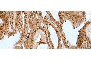 Immunohistochemistry of paraffin-embedded Human thyroid cancer tissue using BCL7B Polyclonal Antibody at dilution of 1:85(x200) (BCL7B 抗体)
