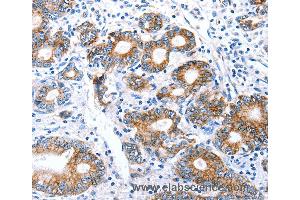 Immunohistochemistry of Human stomach cancer using CLDN7 Polyclonal Antibody at dilution of 1:50 (Claudin 7 抗体)