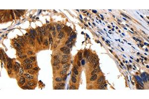 Immunohistochemistry of paraffin-embedded Human colon cancer using 14-3-3 beta/alpha Polyclonal Antibody at dilution of 1:30 (YWHAB 抗体)