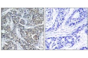 Immunohistochemical analysis of paraffin-embedded human breast carcinoma tissue, using Stathmin 1 (Ab-15) antibody (E021227). (Stathmin 1 抗体)