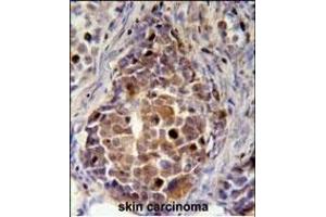 RDH16 Antibody (N-term (ABIN651647 and ABIN2840343) immunohistochemistry analysis in formalin fixed and paraffin embedded human skin carcinoma followed by peroxidase conjugation of the secondary antibody and DAB staining. (RDH16 抗体  (N-Term))