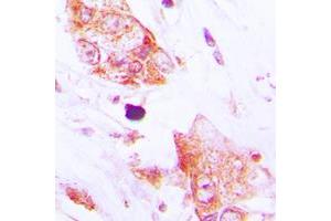 Immunohistochemical analysis of CDC42EP2 staining in human lung cancer formalin fixed paraffin embedded tissue section. (CDC42EP2 抗体  (N-Term))