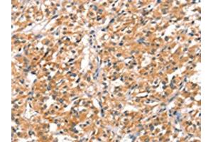 The image on the left is immunohistochemistry of paraffin-embedded Human thyroid cancer tissue using ABIN7192186(RHOBTB2 Antibody) at dilution 1/30, on the right is treated with synthetic peptide. (RHOBTB2 抗体)