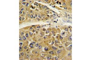 Formalin-fixed and paraffin-embedded human hepatocarcinoma reacted with SERPINA7 Antibody (C-term), which was peroxidase-conjugated to the secondary antibody, followed by DAB staining. (SERPINA7 抗体  (C-Term))