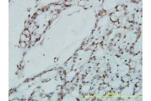 Immunoperoxidase of monoclonal antibody to RPL39L on formalin-fixed paraffin-embedded human ovary, clear cell carcinoma tissue. (RPL39L 抗体  (AA 1-51))