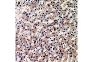 Immunohistochemical analysis of CIDEB staining in human liver cancer formalin fixed paraffin embedded tissue section. (CIDEB 抗体)