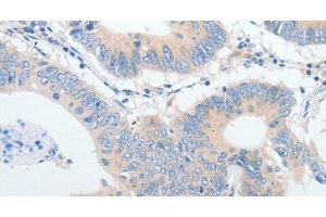 Immunohistochemistry of paraffin-embedded Human colon cancer using IGFBP1 Polyclonal Antibody at dilution of 1:30 (IGFBPI 抗体)