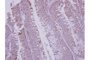 IHC-P Image Immunohistochemical analysis of paraffin-embedded human colon carcinoma, using BMP10, antibody at 1:250 dilution. (BMP10 抗体  (C-Term))