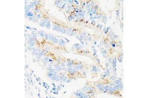 Immunohistochemistry of paraffin-embedded Human colon carcinoma using M Rabbit pAb (ABIN7268390) at dilution of 1:100 (40x lens). (MAN1A2 抗体  (AA 60-180))