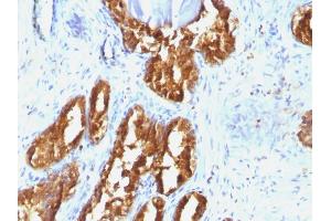 Formalin-fixed, paraffin-embedded human Prostate Carcinoma stained with PSAP Mouse Monoclonal Antibody (ACPP/1338). (ACPP 抗体)