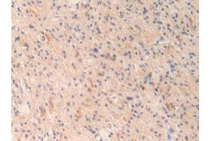 IHC-P analysis of Human Glioma Tissue, with DAB staining. (OIT3 抗体  (AA 297-506))