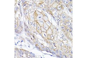 Immunohistochemistry of paraffin-embedded human esophageal cancer using SEMF Rabbit pAb (ABIN6132835, ABIN6147521, ABIN6147522 and ABIN6214683) at dilution of 1:200 (40x lens). (SEMA4F 抗体  (AA 280-420))