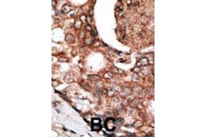 Formalin-fixed and paraffin-embedded human cancer tissue reacted with the primary antibody, which was peroxidase-conjugated to the secondary antibody, followed by DAB staining. (MLLT6 抗体  (C-Term))