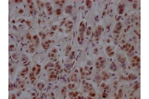 IHC image of ABIN7127781 diluted at 1:100 and staining in paraffin-embedded human breast cancer performed on a Leica BondTM system. (Recombinant PTBP1 抗体)