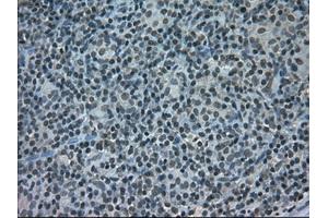 Immunohistochemical staining of paraffin-embedded Carcinoma of pancreas tissue using anti-STAT1mouse monoclonal antibody. (STAT1 抗体)