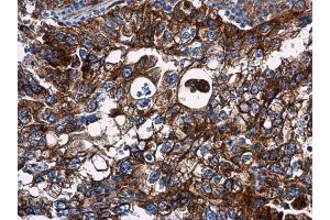 IHC-P Image VCAM1 / CD106 antibody detects VCAM1 / CD106 protein at cell membrane in human endometrial carcinoma by immunohistochemical analysis. (VCAM1 抗体)