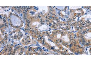 Immunohistochemistry of paraffin-embedded Human thyroid cancer tissue using UCK1 Polyclonal Antibody at dilution 1:50 (UCK1 抗体)