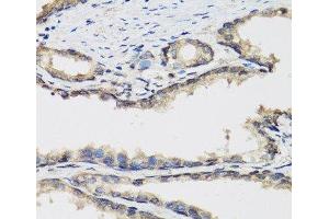 Immunohistochemistry of paraffin-embedded Human prostate using PLA2G7 Polyclonal Antibody at dilution of 1:100 (40x lens). (PLA2G7 抗体)