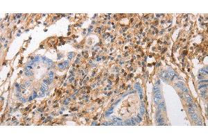 Immunohistochemistry of paraffin-embedded Human colon cancer using INA Polyclonal Antibody at dilution of 1:50 (INA 抗体)