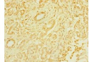 Immunohistochemistry of paraffin-embedded human pancreatic cancer using ABIN7171535 at dilution of 1:100 (TAS1R3 抗体  (AA 400-570))