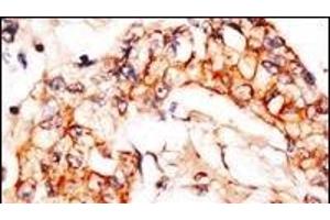 Formalin-fixed and paraffin-embedded human breast carcinoma reacted with anti-PBP1 Antibody (C-term), which was peroxidase-conjugated to the secondary antibody, followed by DAB staining. (NAE1 抗体  (C-Term))