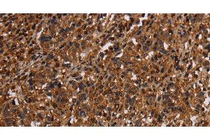 Immunohistochemistry of paraffin-embedded Human liver cancer tissue using MAGEC2 Polyclonal Antibody at dilution 1:40 (MAGEC2 抗体)