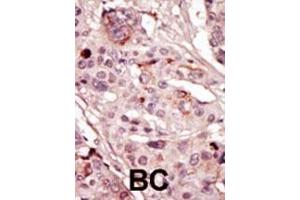 Formalin-fixed and paraffin-embedded human cancer tissue reacted with the primary antibody, which was peroxidase-conjugated to the secondary antibody, followed by AEC staining. (SRMS 抗体  (N-Term))